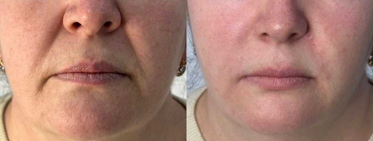 Face treatment result